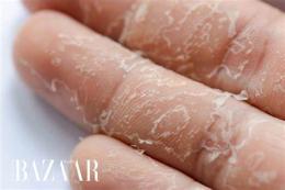 ảnh chụp màn hình bị bong da tay là thiếu chất gì