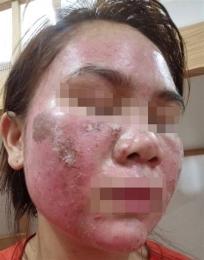 ảnh chụp màn hình da mặt bị bong tróc đỏ rát