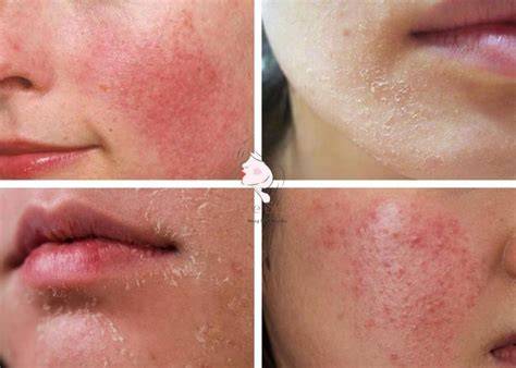 ảnh chụp màn hình dùng tretinoin bị bong da nên làm gì