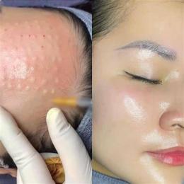 ảnh chụp màn hình tiêm meso căng bóng da