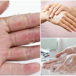 bị bong da tay là bị sao