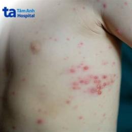 bỏng dạ và thủy đậu