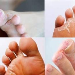 chân bị bong da