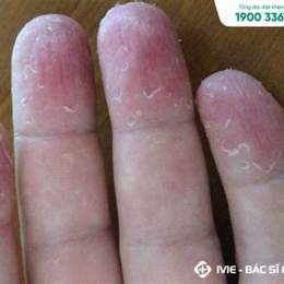 da bị bong tróc ở tay chân
