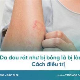 da đau rát như bị bỏng
