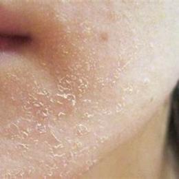 da mặt bị khô bong tróc