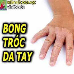 da tay bị bong tróc khô