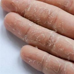 da tay bị khô bong tróc