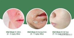 giao diện app peel da bao lâu thì bong hết
