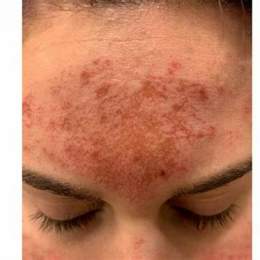 hình ảnh peel da bị bỏng