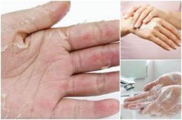 hướng dẫn sử dụng da tay bong tróc