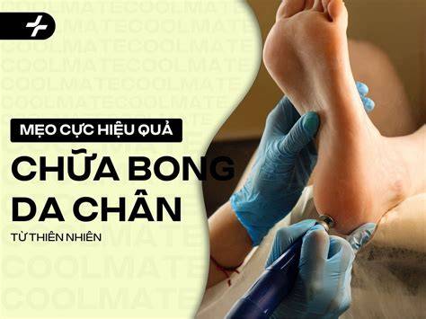 hướng dẫn sử dụng mẹo chữa bong da chân