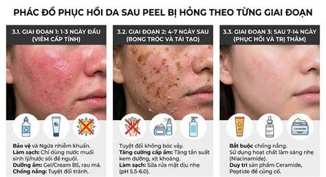hướng dẫn sử dụng peel da bị bỏng