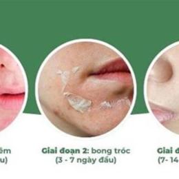 peel da bao lâu thì bong hết