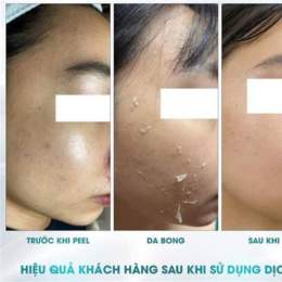 peel da không bong