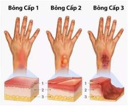 tính năng nổi bật bị bỏng dạ