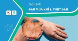tính năng nổi bật bỏng dạ và thủy đậu