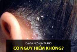 tính năng nổi bật da đầu bị bong tróc