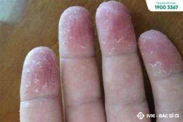 tính năng nổi bật đầu ngón tay bị bong tróc da là bệnh gì
