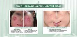 tính năng nổi bật hình ảnh peel da bị bỏng