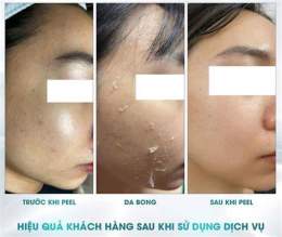 tính năng nổi bật peel da không bong