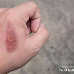 vết bỏng bị tróc da nên bôi gì